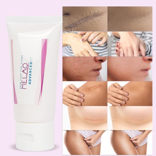 Melao Scar Removal Cream in Pakistan